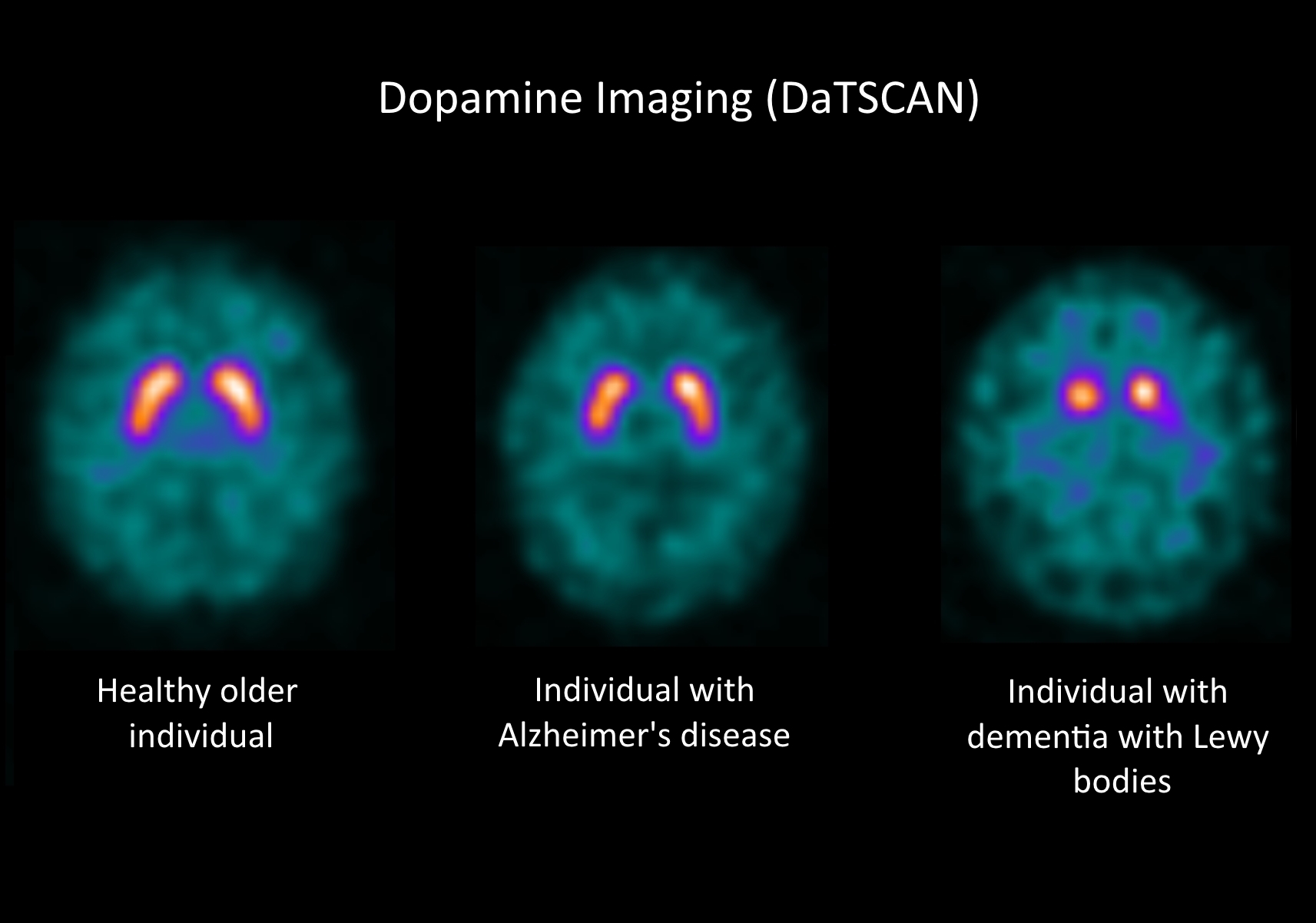 Dopamine Imaging (DaTSCAN)